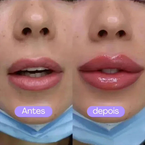 Plump Lip - Botox imediato